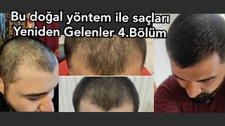 Dökülen Saçların Yeniden Çıkması / Yeniden Saç Çıkarma! 4. Bölüm (#saçbakımıyöntemleri)