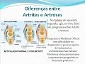 Artrite & Artrose. Difícil diagnóstico e incurável para a Medicina. Já a Acupuntura e a Quântica...