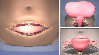 Abdominal Myomectomy through Maylard incision | TVASurg