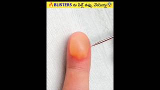 🔥BLISTERS ను పేల్చే తప్పు చేయొద్దు😨#shorts #viral