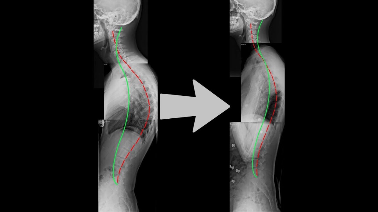 Posture Spine Enhancer Youtube