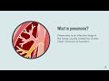 Pneumonia: Symptoms, Diagnosis, Treatment, and Prevention | Merck Manual Consumer Version