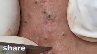 blackheads whiteheads removal pimple popping compilation new this week spa treatment 2025  กดสิว 🥺