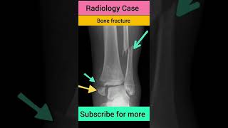 #radiology #radiographer #radio #bone #fracture #xray #xrays #radiography #trendingshorts #trending