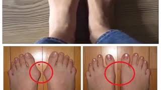 د.شوق.العلاج الطبيعى هذايصيب بروز عظمة ابهام الرجل..  physicaltherapy  #hallux#