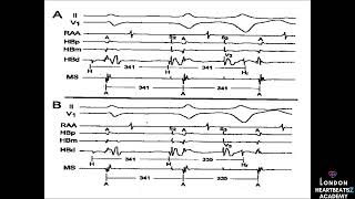 Diploma in Cardiac Electrophysiology -12 rules for EP tracing with 20 practical examples -link below