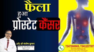 फैला हुआ प्रोस्टेट कैंसर-इलाज के विकल्प Treatment for Stage-4 Prostate Cancer