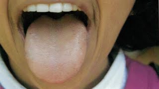 CAUSES OF PALE TONGUE IN TCM