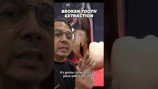 EASY and FAST Tooth Extraction on Cracked Tooth | View Mobile Dental #shorts