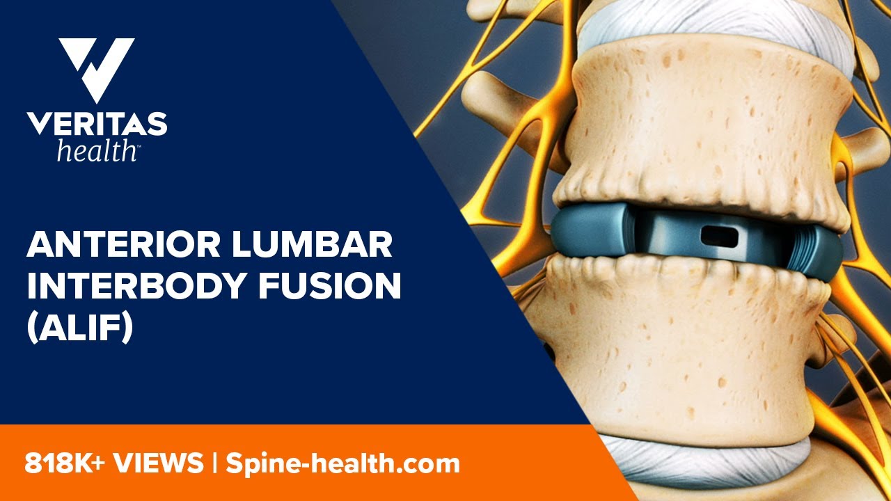 Anterior Lumbar Interbody Fusion (ALIF) - YouTube