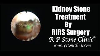 Kidney Stone Treatment by RIRS Surgery | Flexible Ureteroscopy