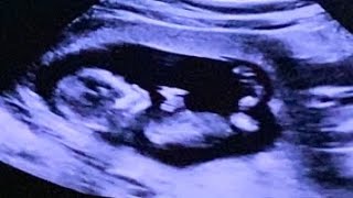 NT Scan at 13 Weeks Pregnancy | Nuchal Translucency Scan 11-14 Weeks Pregnancy