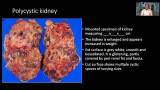 Game 54 | Polycystic kidney | Pathology practical | Charts \u0026 Specimen | SRM | Dr GSS | Univ ques!!!