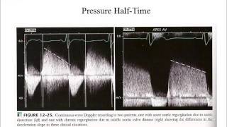 Short review assesssment of severity of AR by ECHO