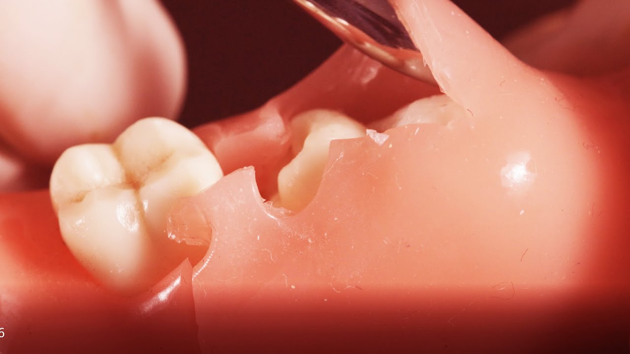 Partially Impacted Wisdom Teeth Removal