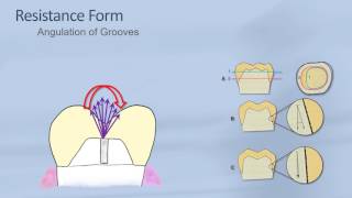 Effect of accessory groove angulation in crown retention