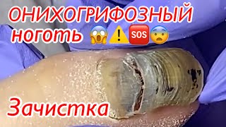 ОНИХОГРИФОЗНЫЙ ноготь😱😱🆘😨❗️ • Зачистка🦶🏻