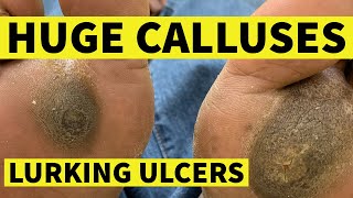 Huge Calluses, Lurking Ulcers