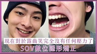 【SOV舒服美】王庭勻 - 矯正一年的改變！對於露齒笑已經完全沒有任何壓力了｜數位隱形矯正｜隱形牙套｜無痛矯正