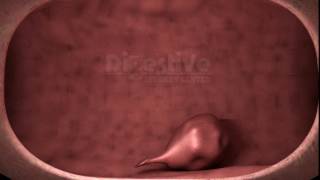 Polyp Detection and Removal. 3D Animation.