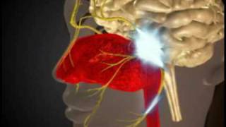 Tolosa Hunt Syndrome