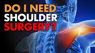 Do I Need Shoulder Surgery?