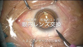 眼内レンズ交換（術後３ヶ月PanOptix→PanOptix）※手術動画