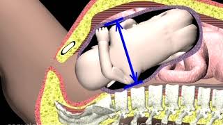 Fetal Dystocia Compound Presentation Animation by Cal Shipley, M.D.