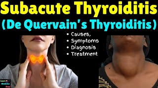 Subacute Thyroiditis (De Quervain’s Thyroiditis) – Causes, Symptoms, Diagnosis and Treatment