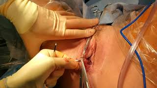 Bartholin s Gland Cyst marsupialization surgery