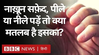 Nails Disease : नाखून अगर सफ़ेद, पीले या फिर नीले पड़ जाएं तो सतर्क हो जाइए (BBC Hindi)