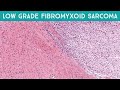 Low grade fibromyxoid sarcoma (Evans Tumor): Cancer that looks SO benign (Oregon Case 9)