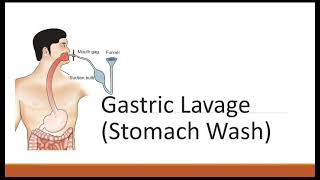 Gastric Lavage/ Stomach Wash