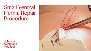 Operative Steps for Small Ventral Hernia Repair Surgery with Dr. George Crawford | J\u0026J MedTech