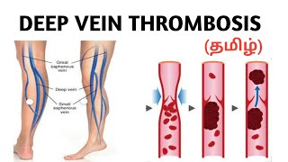 Deep Vein Thrombosis | Causes | Risk factor | Symptoms | Treatment | தமிழ் .