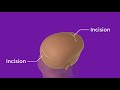 sagittal craniosynostosis surgery