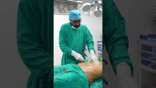 Liposuction surgery Steps #shorts #vaserlipo