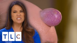 Dr. Lee Treats Anxious Patient With Enormous Forehead Cyst | Dr. Pimple Popper