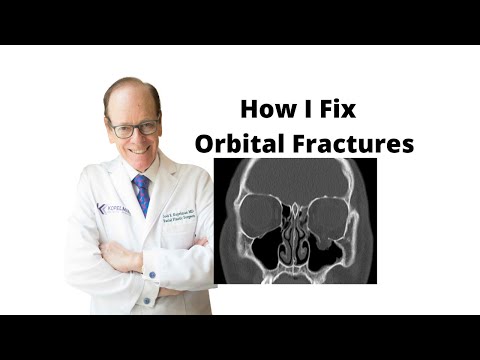 How easy is it to break your orbital bone?