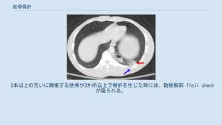 肋骨骨折