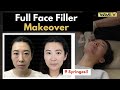 Full Face Filler Makeover | Dramatic Before and After! | Wave Plastic Surgery