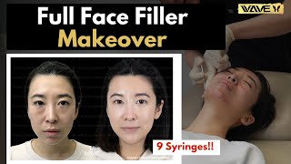 Full Face Filler Makeover | Dramatic Before and After! | Wave Plastic Surgery