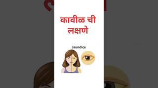 कावीळ ची लक्षणे #कावीळ #पिवळाकावीळ #jaundice #health #liver #facts #yellowskin #fever #shorts#लक्षणे