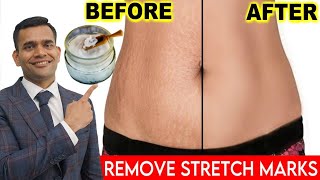 1 Best Remedy To Remove Stretch Marks | How To Remove Stretch Marks - Dr. Vivek Joshi