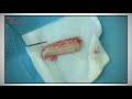 connective tissue graft fgg for multiple recessions microsurgery u0026 er yag laser assisted