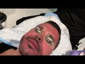 SMOOTHEN SCARS AND REMOVE PIGMENTATION WITH SCITON MOXI LOW DOWNTIME LASER FACIAL| Dr. Jason Emer