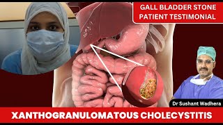 Patient Feedback after Gall stone Surgery ! xanthogranulomatous cholecystitis ! \u0026 Complications