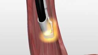 Barrx 90 RFA Focal Catheter Animation m4v