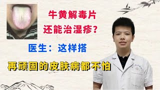 牛黄解毒片还能治湿疹？医生：这样搭，再顽固的皮肤病都不怕