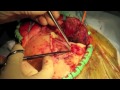 pterional craniotomy videos